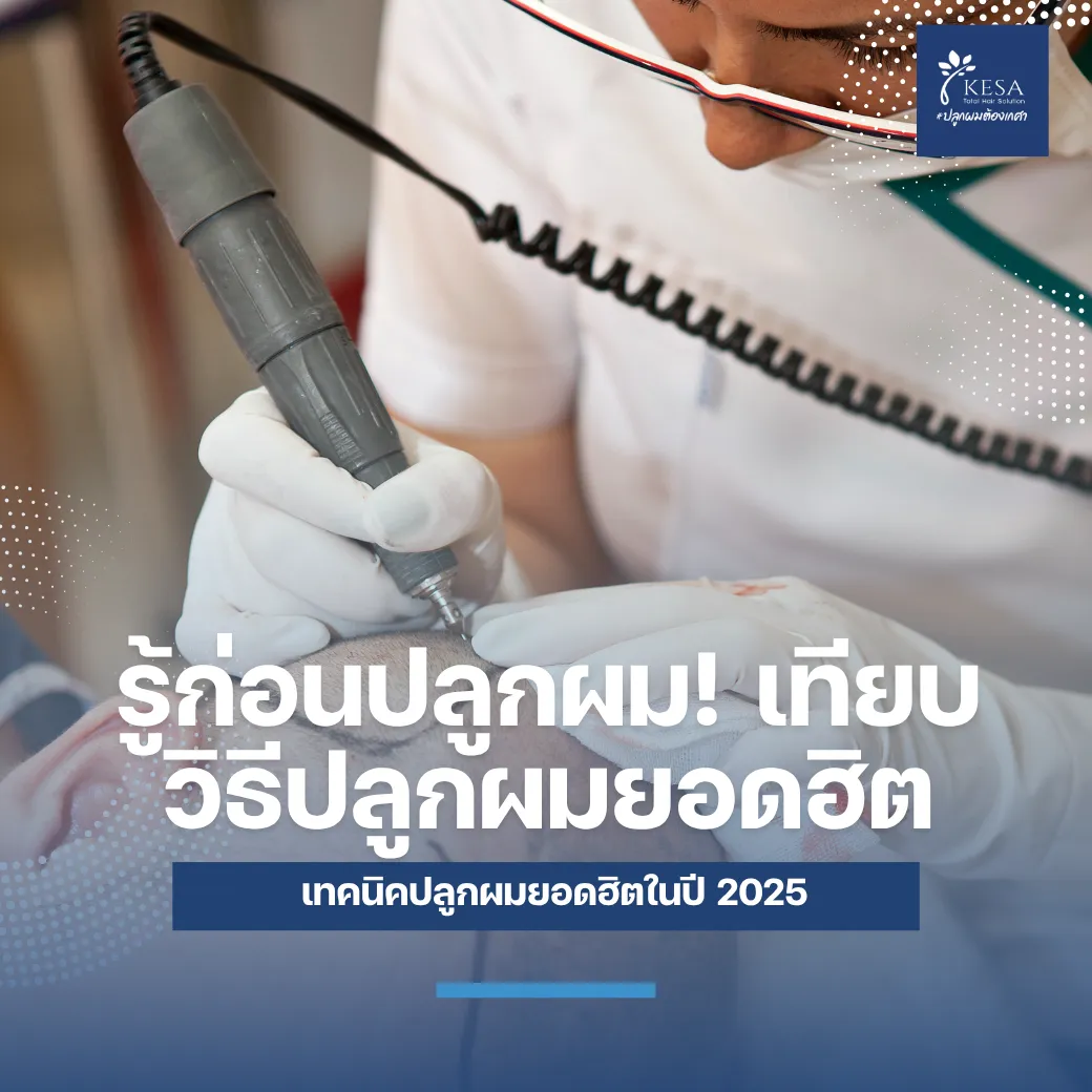รู้ก่อนปลูกผม! เทียบวิธีปลูกผมยอดฮิต เกศา คลินิก - kesa hair clinic
