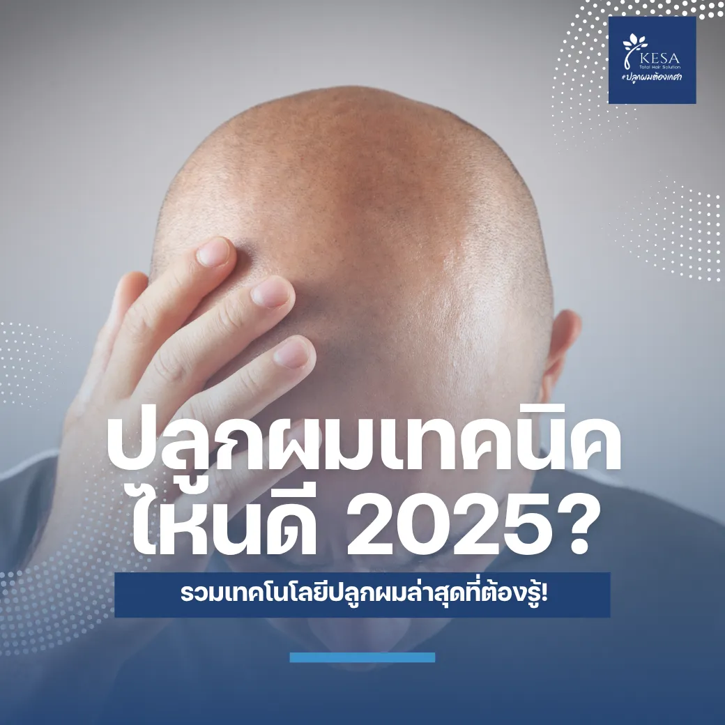 ปลูกผมเทคนิคไหนดี 2025? รวมเทคโนโลยีปลูกผมล่าสุดที่ต้องรู้! เกศา คลินิก - kesa hair clinic
