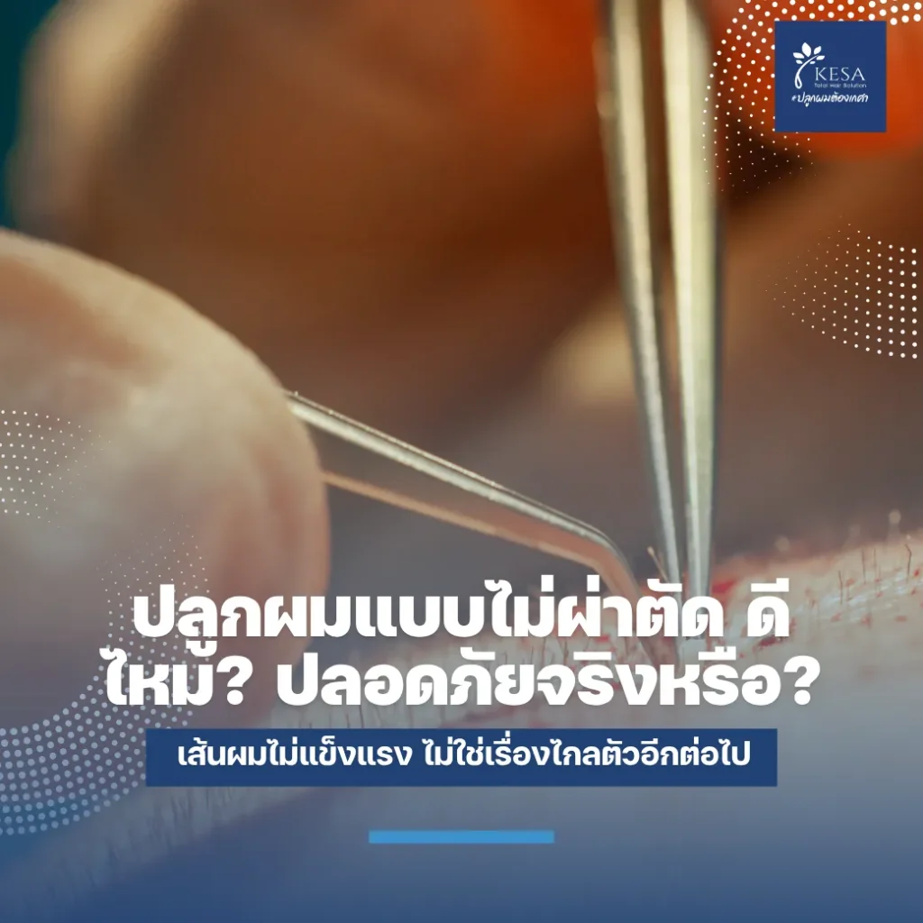 ปลูกผมแบบไม่ผ่าตัด ดีไหม? ปลอดภัยจริงหรือ? เกศา คลินิก - kesa hair clinic