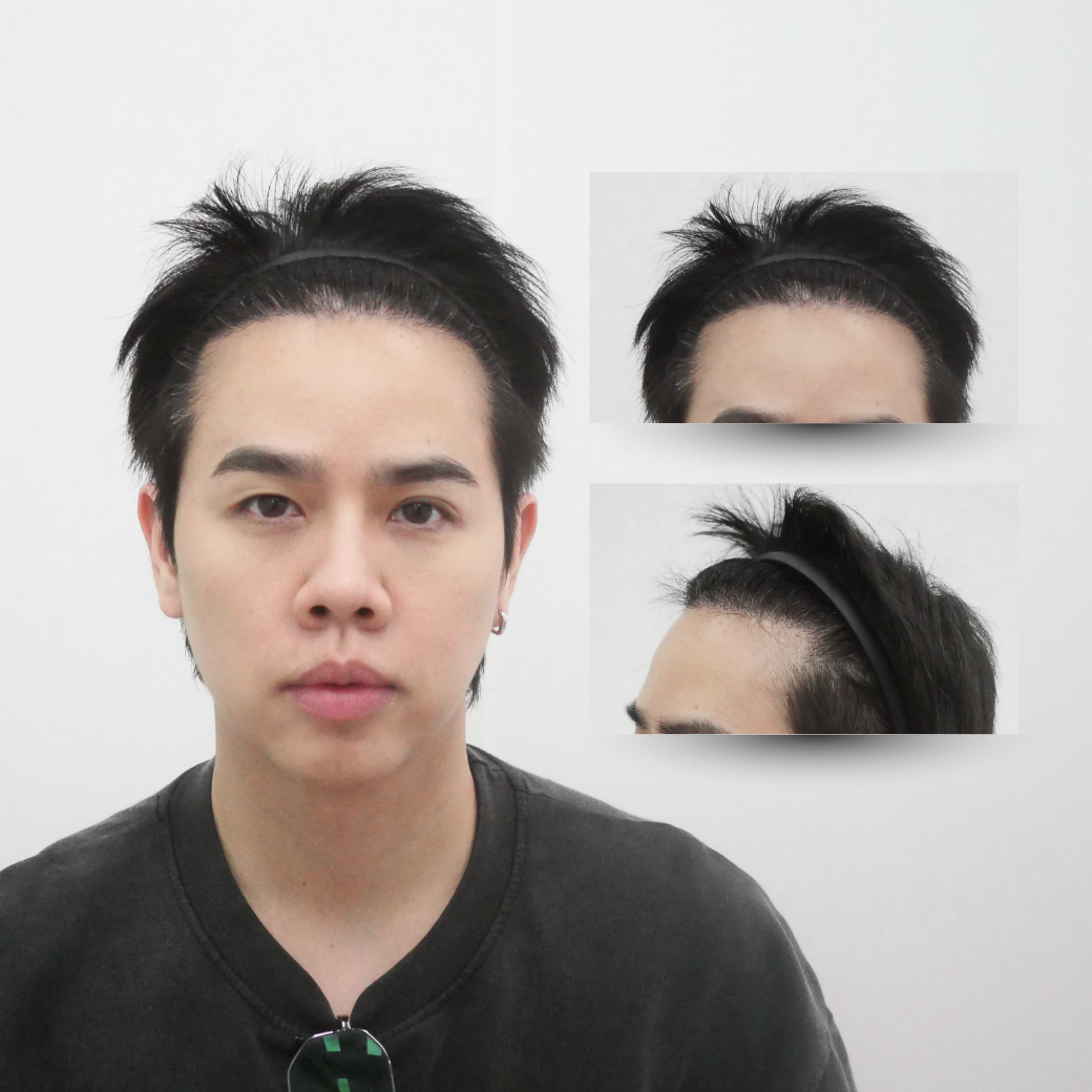 ปลูกผม เกศา คลินิก - kesa hair clinic