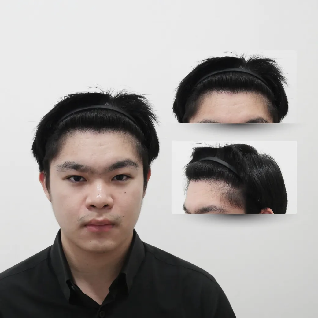 ปลูกผม เกศา คลินิก - kesa hair clinic