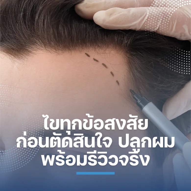 ไขทุกข้อสงสัยก่อนตัดสินใจ ปลูกผม พร้อมรีวิวจริง เกศา คลินิก - kesa hair clinic