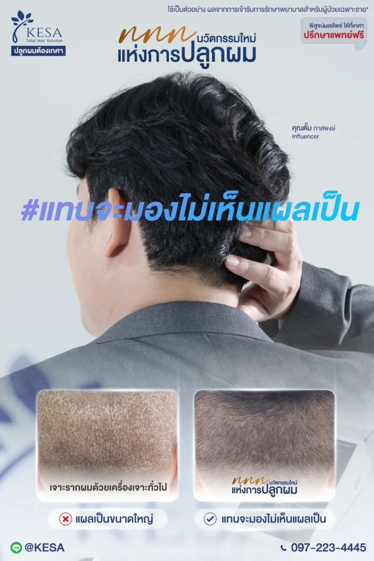 ปลูกผมที่ไหนดี 2569 เกศา คลินิก - kesa hair clinic