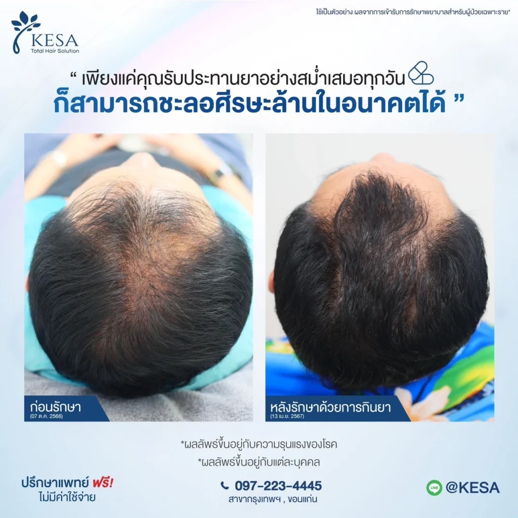 ผมบางกรรมพันธุ์ รักษาด้วย Minoxidil เกศา คลินิก - kesa hair clinic เกศา คลินิก - kesa hair clinic