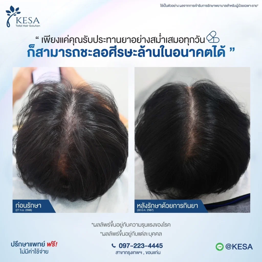 ผมบางกรรมพันธุ์ รักษาด้วย ไมน็อกซิดิล เกศา คลินิก - kesa hair clinic เกศา คลินิก - kesa hair clinic