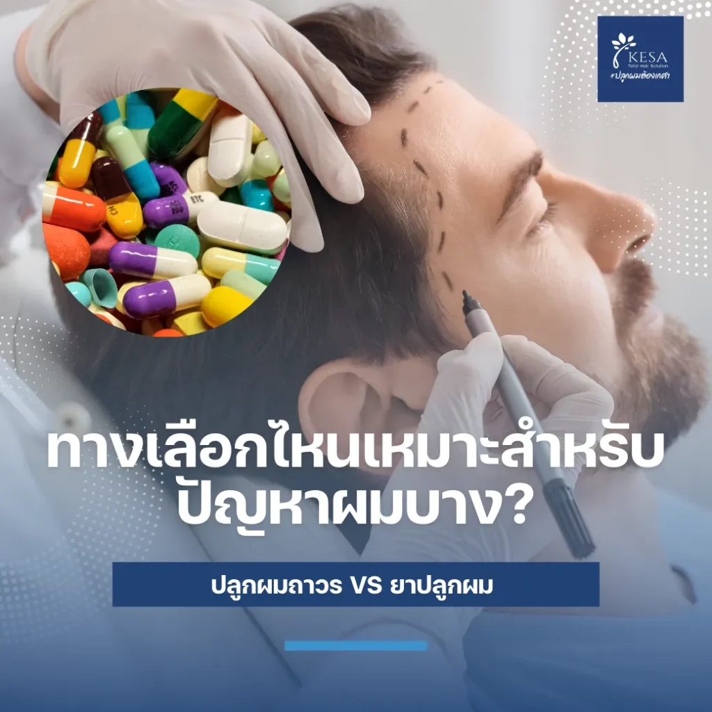 ปลูกผม vs ยาปลูกผม เกศา คลินิก - kesa hair clinic