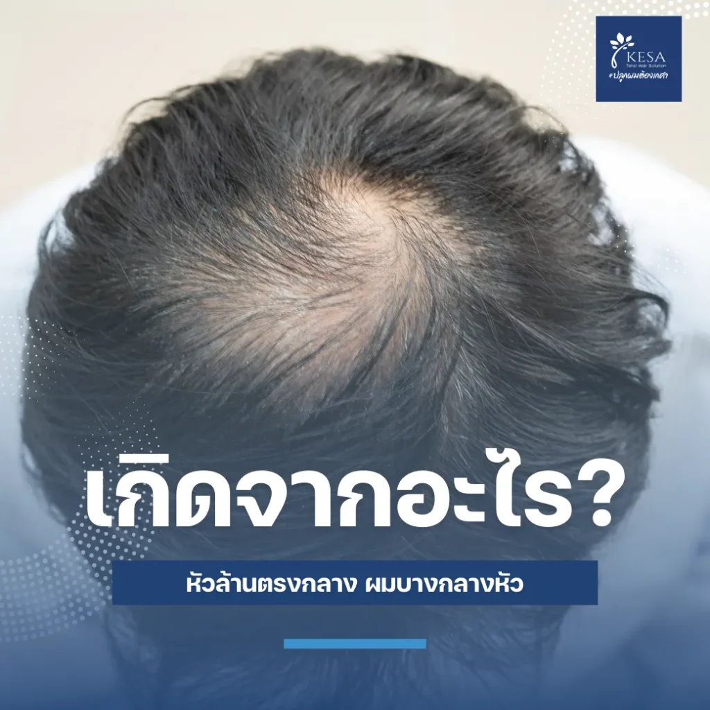 ผทบางกลางหัว เกศา คลินิก - kesa hair clinic