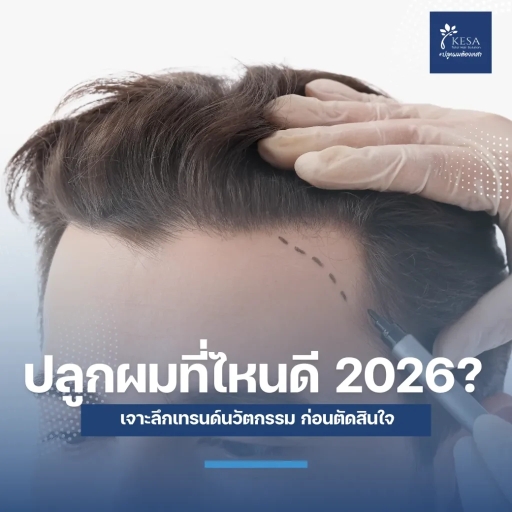 ปลูกผมที่ไหนดี 2026 เกศา คลินิก - kesa hair clinic