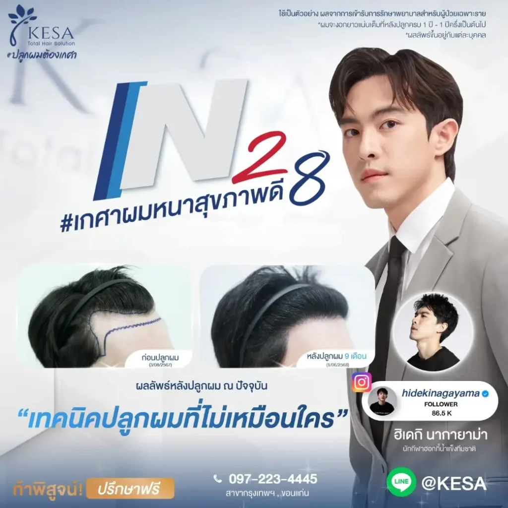 ปลูกผมผู้ชาย ที่ไหนดี เกศา คลินิก - kesa hair clinic
