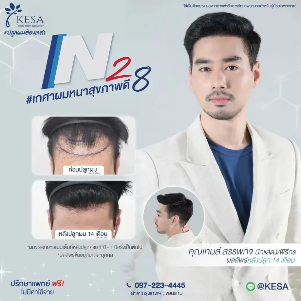 ปลูกผมผู้ชาย N28 เกศา คลินิก - kesa hair clinic