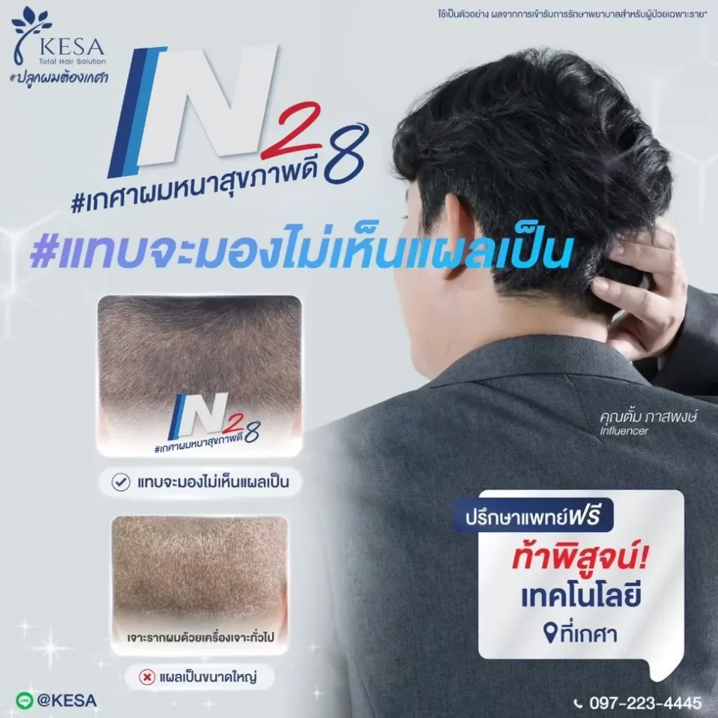 ปลูกผมผู้ชาย N28 เกศา คลินิก - kesa hair clinic