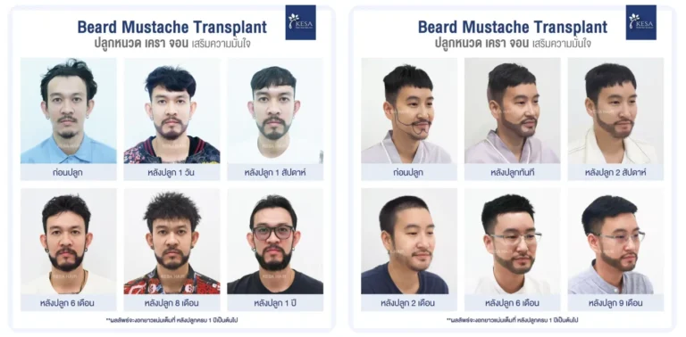 content-img-1b51fd9-1 – เกศา คลินิก - kesa hair clinic – เกศา คลินิก - kesa hair clinic Beard and mustache transplant progress gallery: two panels with 12 men’s before-and-after photos showing timelines (left: before, 1 day, 1 week, 6–8 months, 1 year; right: before, immediately after, 2 weeks, 2 months, 6–9 months). เกศา คลินิก - kesa hair clinic เกศา คลินิก - kesa hair clinic