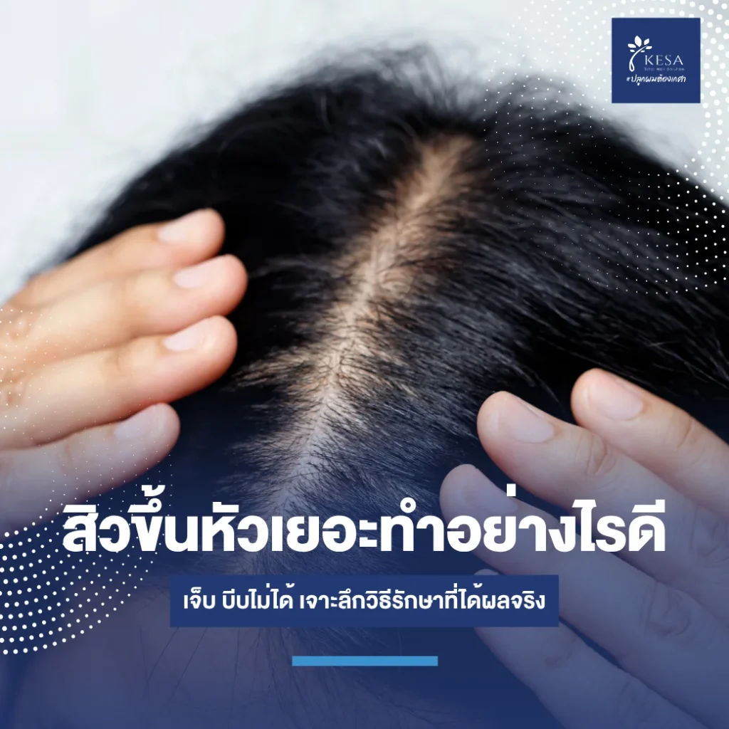 featured-acne-on-scalp-causes-5 – เกศา คลินิก - kesa hair clinic – เกศา คลินิก - kesa hair clinic สิวขึ้นหัวเยอะทำอย่างไรดี เกศา คลินิก - kesa hair clinic เกศา คลินิก - kesa hair clinic