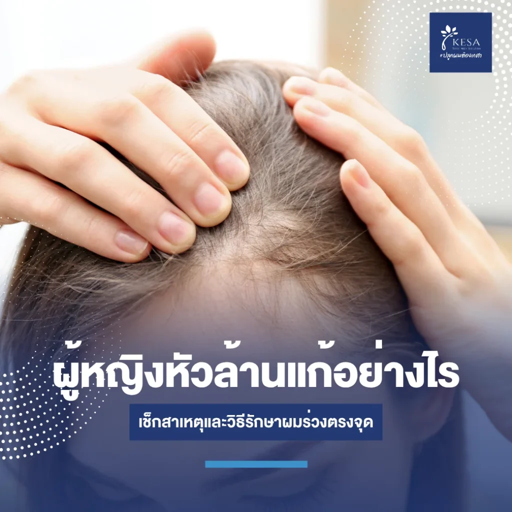 featured-female-baldness-prevention-4 – เกศา คลินิก - kesa hair clinic – เกศา คลินิก - kesa hair clinic ผู้หญิงหัวล้านแก้อย่างไร เกศา คลินิก - kesa hair clinic เกศา คลินิก - kesa hair clinic