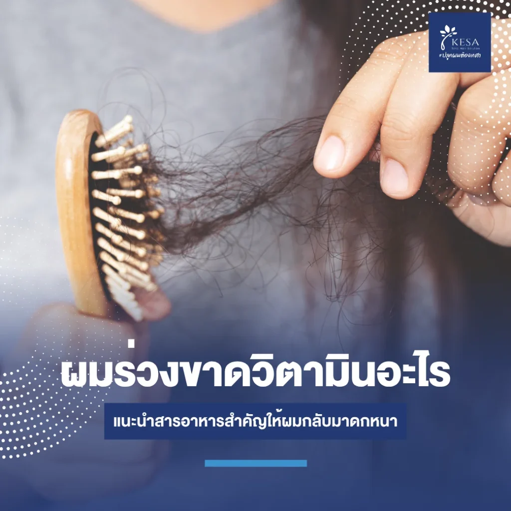 featured-hair-loss-vitamin-deficiency-5 – เกศา คลินิก - kesa hair clinic – เกศา คลินิก - kesa hair clinic ผมร่วงขาดวิตามินอะไร เกศา คลินิก - kesa hair clinic เกศา คลินิก - kesa hair clinic