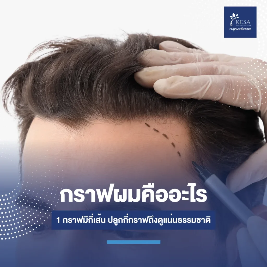 featured-what-is-hair-graft-for-hair-transplant-5 – เกศา คลินิก - kesa hair clinic – เกศา คลินิก - kesa hair clinic กราฟผมคืออะไร 1 กราฟมีกี่เส้น เกศา คลินิก - kesa hair clinic เกศา คลินิก - kesa hair clinic