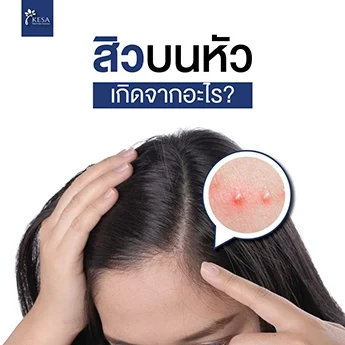 สิว บนหัว